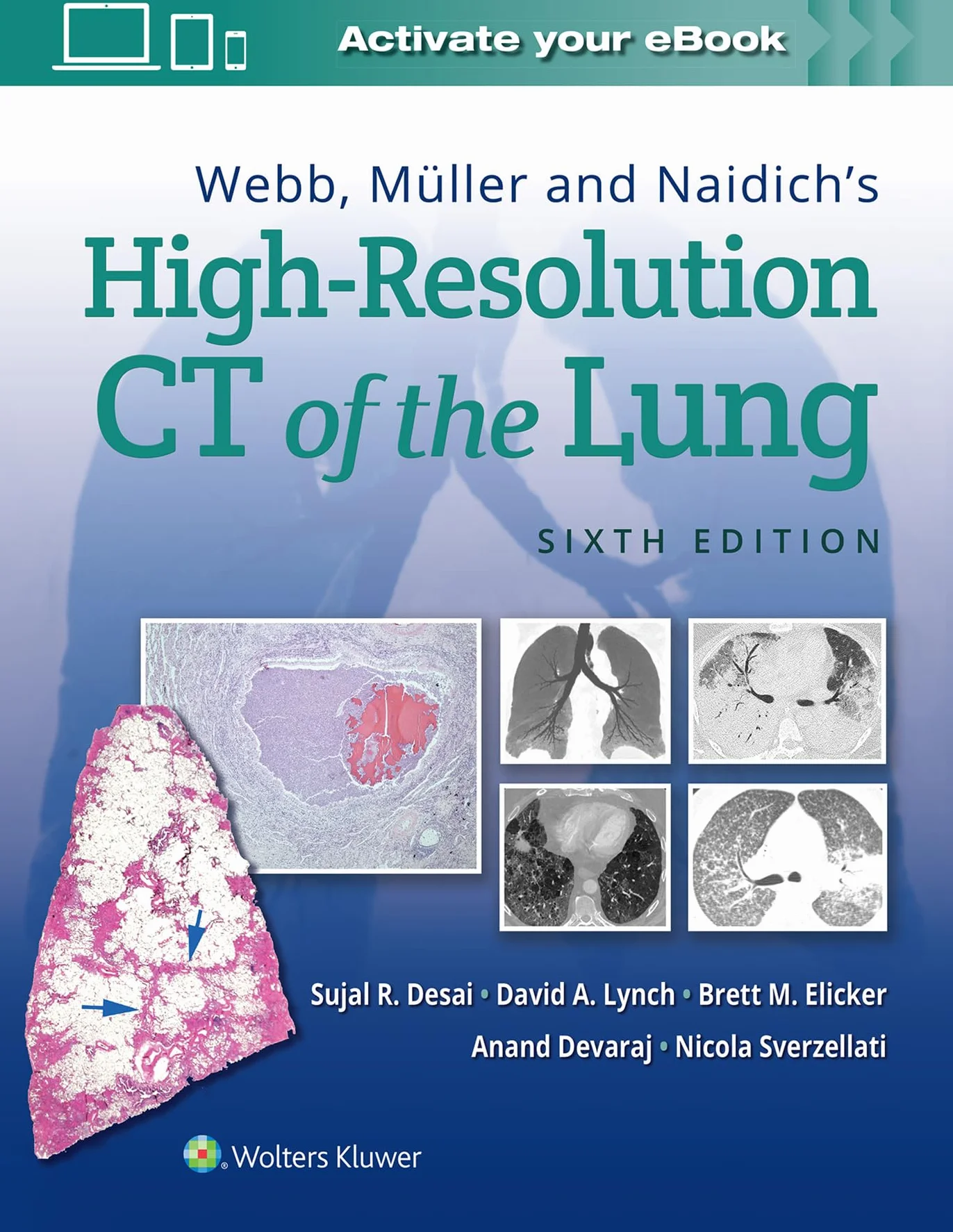 Webb, Müller and Naidich's High-Resolution CT of the Lung