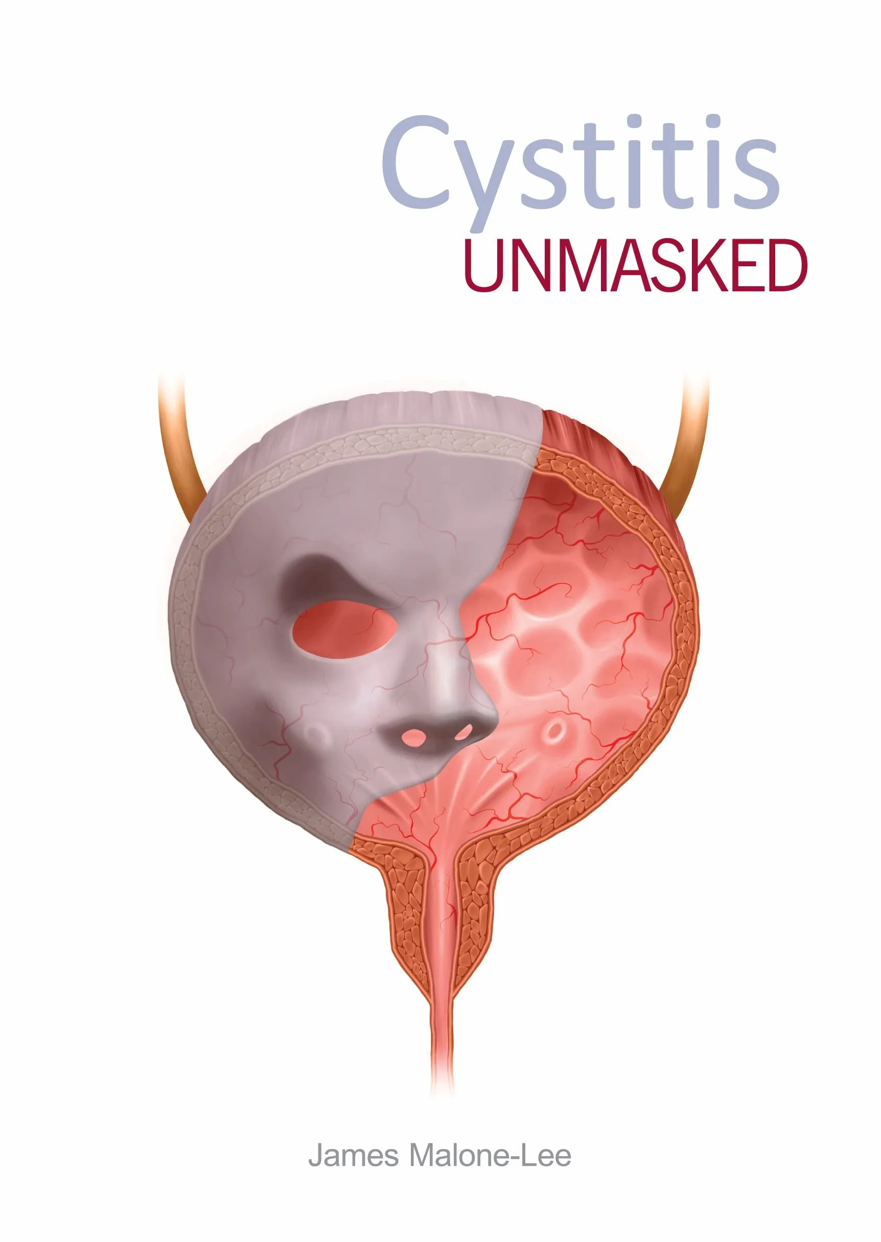 Cystitis Unmasked