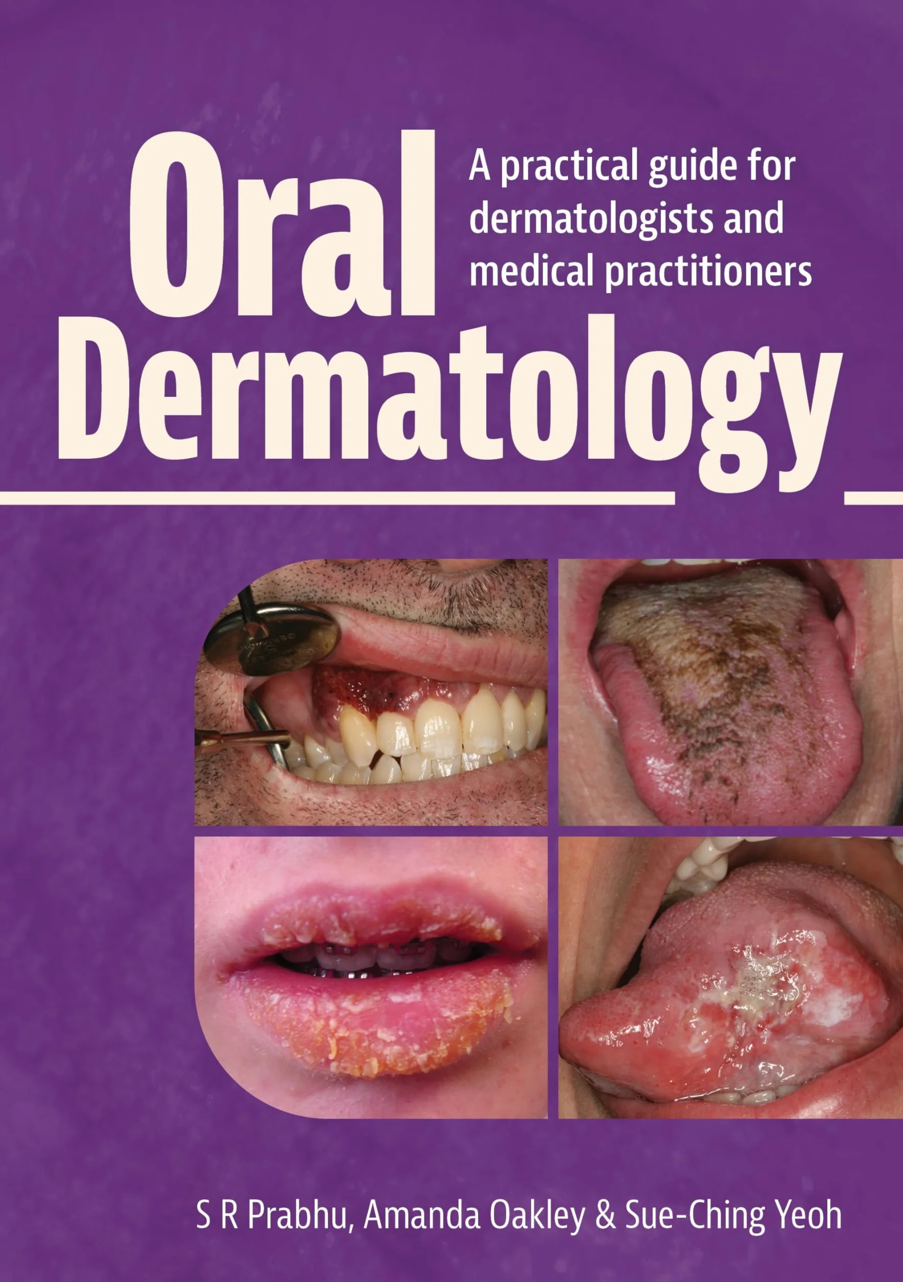 Oral Dermatology: A practical guide for dermatologists and medical practitioners